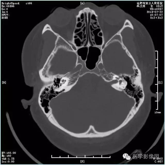 【病例】左侧桥小脑角转移性腺癌侵犯听神经1例CT及MR影像表现 【病例】左侧桥小脑角转移性腺癌侵犯听神经1例CT及MR影像表现