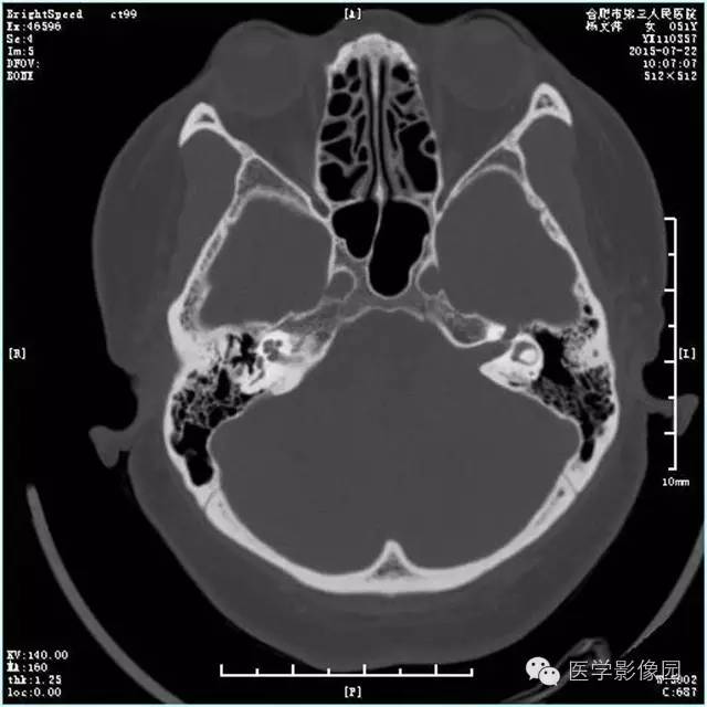 【病例】左侧桥小脑角转移性腺癌侵犯听神经1例CT及MR影像表现 【病例】左侧桥小脑角转移性腺癌侵犯听神经1例CT及MR影像表现