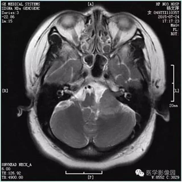 【病例】左侧桥小脑角转移性腺癌侵犯听神经1例CT及MR影像表现 【病例】左侧桥小脑角转移性腺癌侵犯听神经1例CT及MR影像表现