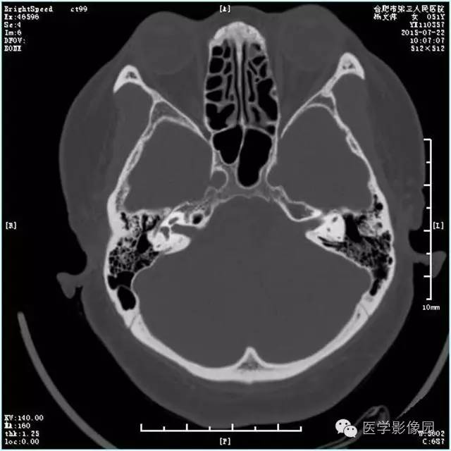 【病例】左侧桥小脑角转移性腺癌侵犯听神经1例CT及MR影像表现 【病例】左侧桥小脑角转移性腺癌侵犯听神经1例CT及MR影像表现