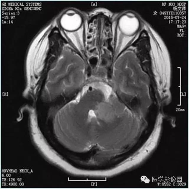 【病例】左侧桥小脑角转移性腺癌侵犯听神经1例CT及MR影像表现 【病例】左侧桥小脑角转移性腺癌侵犯听神经1例CT及MR影像表现