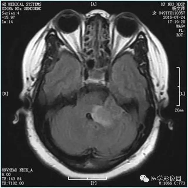 【病例】左侧桥小脑角转移性腺癌侵犯听神经1例CT及MR影像表现 【病例】左侧桥小脑角转移性腺癌侵犯听神经1例CT及MR影像表现