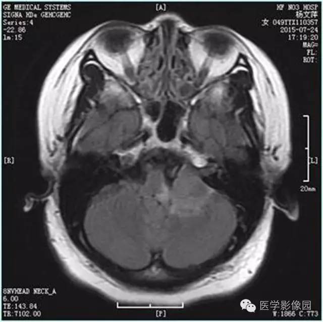 【病例】左侧桥小脑角转移性腺癌侵犯听神经1例CT及MR影像表现 【病例】左侧桥小脑角转移性腺癌侵犯听神经1例CT及MR影像表现