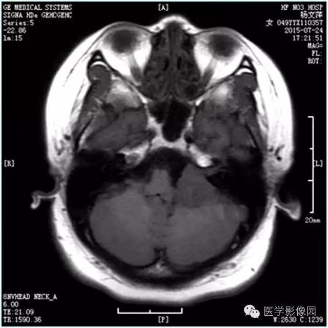 【病例】左侧桥小脑角转移性腺癌侵犯听神经1例CT及MR影像表现 【病例】左侧桥小脑角转移性腺癌侵犯听神经1例CT及MR影像表现