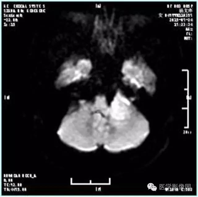 【病例】左侧桥小脑角转移性腺癌侵犯听神经1例CT及MR影像表现 【病例】左侧桥小脑角转移性腺癌侵犯听神经1例CT及MR影像表现