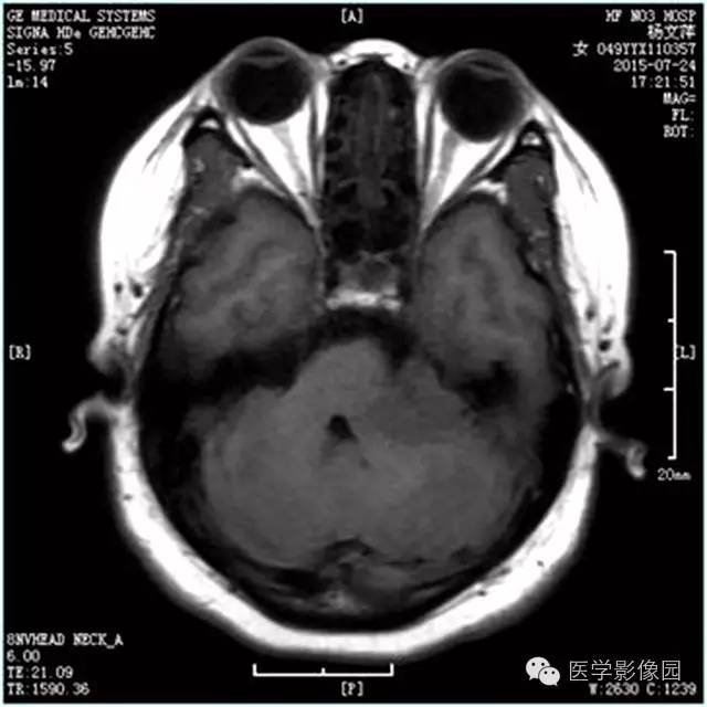 【病例】左侧桥小脑角转移性腺癌侵犯听神经1例CT及MR影像表现 【病例】左侧桥小脑角转移性腺癌侵犯听神经1例CT及MR影像表现