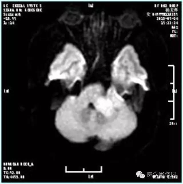 【病例】左侧桥小脑角转移性腺癌侵犯听神经1例CT及MR影像表现 【病例】左侧桥小脑角转移性腺癌侵犯听神经1例CT及MR影像表现