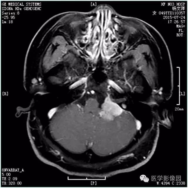 【病例】左侧桥小脑角转移性腺癌侵犯听神经1例CT及MR影像表现 【病例】左侧桥小脑角转移性腺癌侵犯听神经1例CT及MR影像表现
