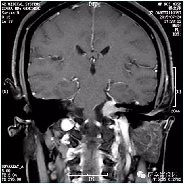 【病例】左侧桥小脑角转移性腺癌侵犯听神经1例CT及MR影像表现 【病例】左侧桥小脑角转移性腺癌侵犯听神经1例CT及MR影像表现