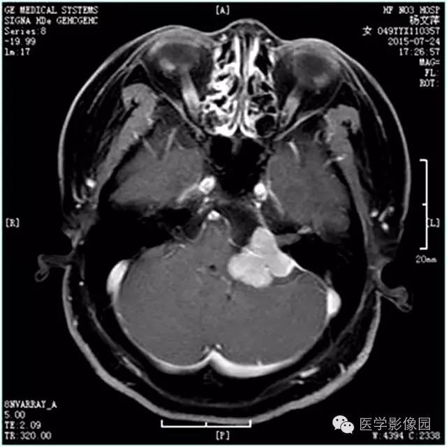 【病例】左侧桥小脑角转移性腺癌侵犯听神经1例CT及MR影像表现 【病例】左侧桥小脑角转移性腺癌侵犯听神经1例CT及MR影像表现