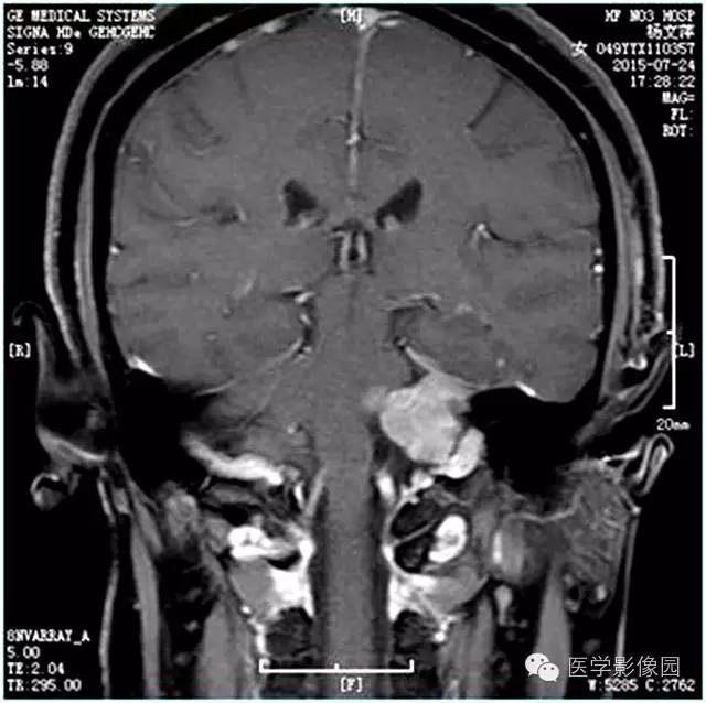 【病例】左侧桥小脑角转移性腺癌侵犯听神经1例CT及MR影像表现 【病例】左侧桥小脑角转移性腺癌侵犯听神经1例CT及MR影像表现