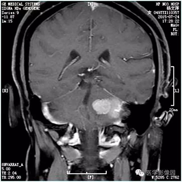 【病例】左侧桥小脑角转移性腺癌侵犯听神经1例CT及MR影像表现 【病例】左侧桥小脑角转移性腺癌侵犯听神经1例CT及MR影像表现