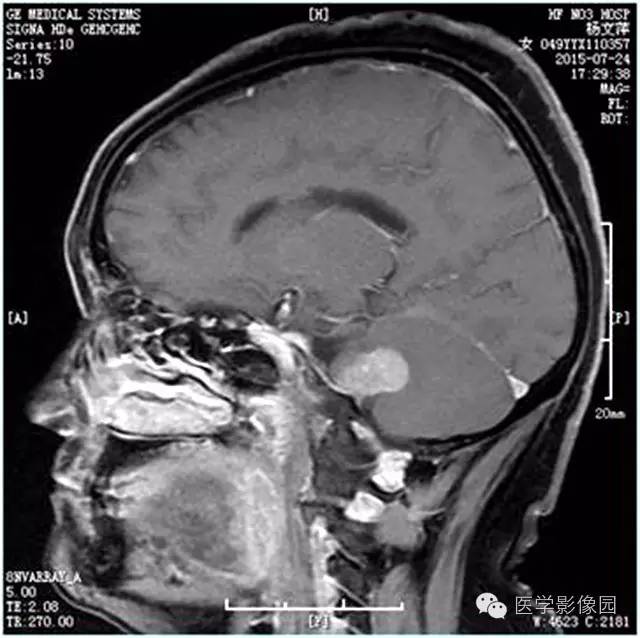 【病例】左侧桥小脑角转移性腺癌侵犯听神经1例CT及MR影像表现 【病例】左侧桥小脑角转移性腺癌侵犯听神经1例CT及MR影像表现