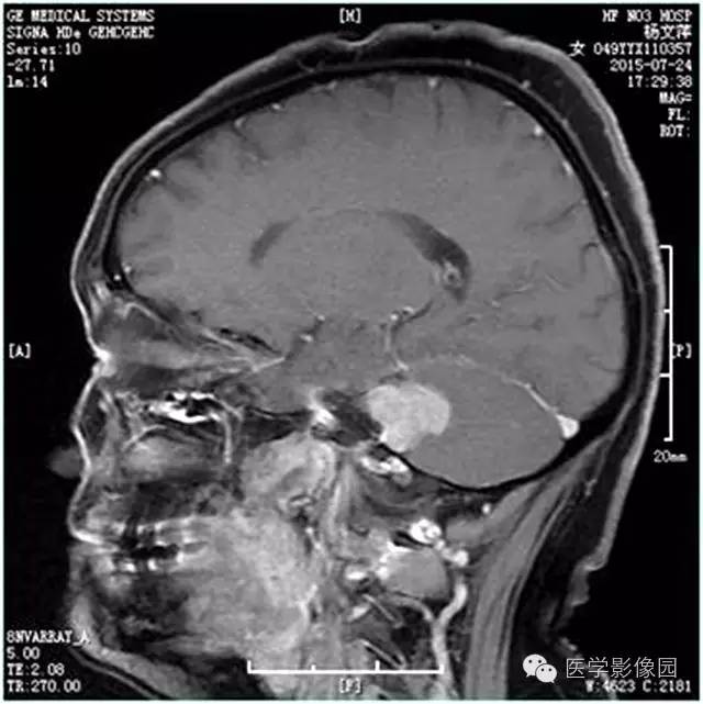 【病例】左侧桥小脑角转移性腺癌侵犯听神经1例CT及MR影像表现 【病例】左侧桥小脑角转移性腺癌侵犯听神经1例CT及MR影像表现