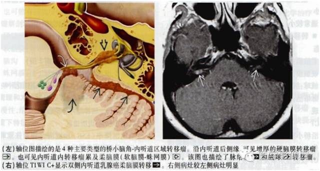 【病例】左侧桥小脑角转移性腺癌侵犯听神经1例CT及MR影像表现 【病例】左侧桥小脑角转移性腺癌侵犯听神经1例CT及MR影像表现