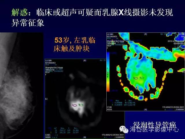 【PPT】乳腺MRI诊断解析 【PPT】乳腺MRI诊断解析