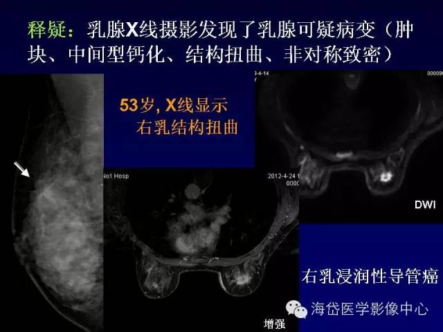 【PPT】乳腺MRI诊断解析 【PPT】乳腺MRI诊断解析