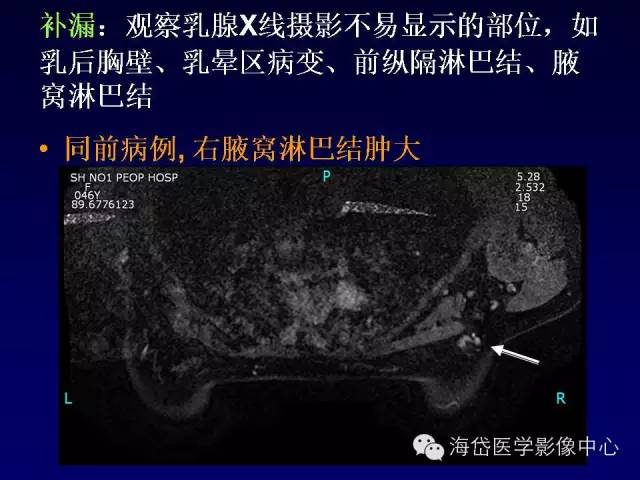 【PPT】乳腺MRI诊断解析 【PPT】乳腺MRI诊断解析