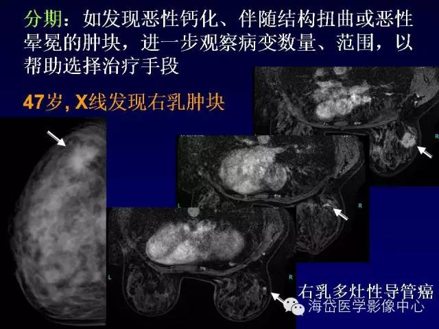 【PPT】乳腺MRI诊断解析 【PPT】乳腺MRI诊断解析