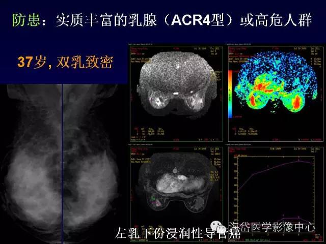 【PPT】乳腺MRI诊断解析 【PPT】乳腺MRI诊断解析