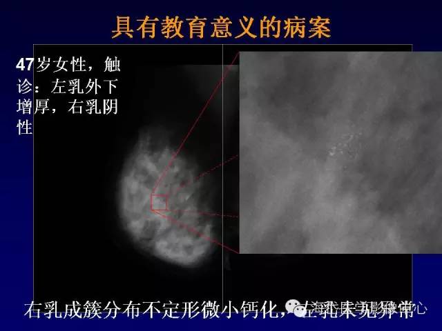 【PPT】乳腺MRI诊断解析 【PPT】乳腺MRI诊断解析