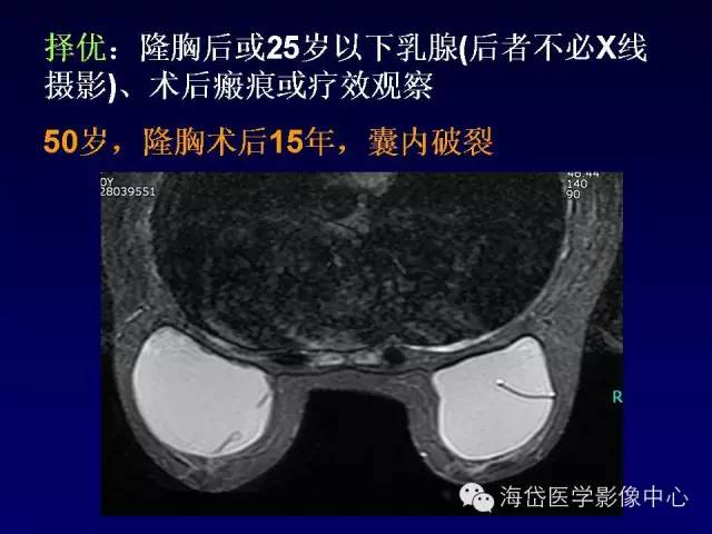 【PPT】乳腺MRI诊断解析 【PPT】乳腺MRI诊断解析