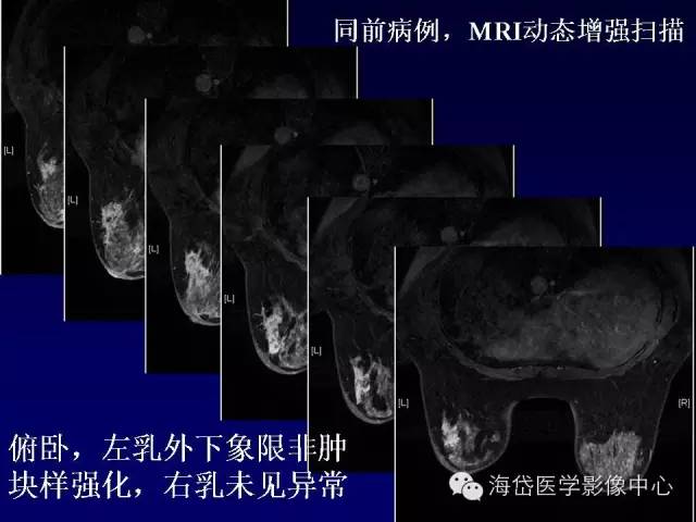 【PPT】乳腺MRI诊断解析 【PPT】乳腺MRI诊断解析