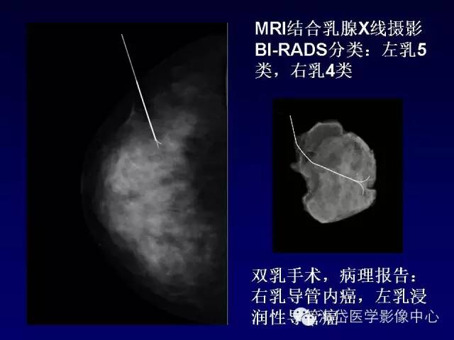 【PPT】乳腺MRI诊断解析 【PPT】乳腺MRI诊断解析