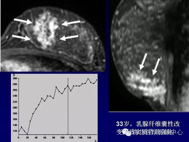 【PPT】乳腺MRI诊断解析 【PPT】乳腺MRI诊断解析