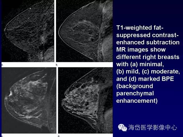 【PPT】乳腺MRI诊断解析 【PPT】乳腺MRI诊断解析