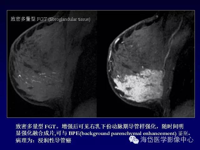 【PPT】乳腺MRI诊断解析 【PPT】乳腺MRI诊断解析