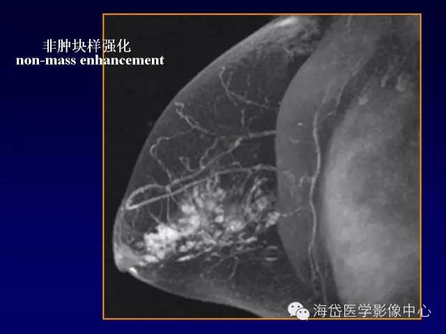 【PPT】乳腺MRI诊断解析 【PPT】乳腺MRI诊断解析