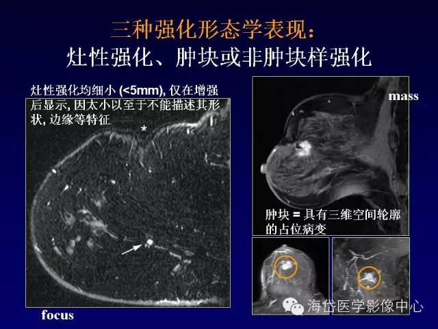 【PPT】乳腺MRI诊断解析 【PPT】乳腺MRI诊断解析