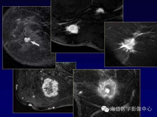 【PPT】乳腺MRI诊断解析 【PPT】乳腺MRI诊断解析