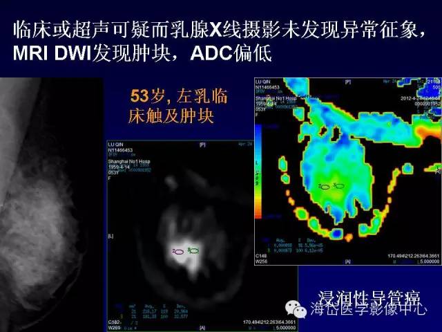 【PPT】乳腺MRI诊断解析 【PPT】乳腺MRI诊断解析