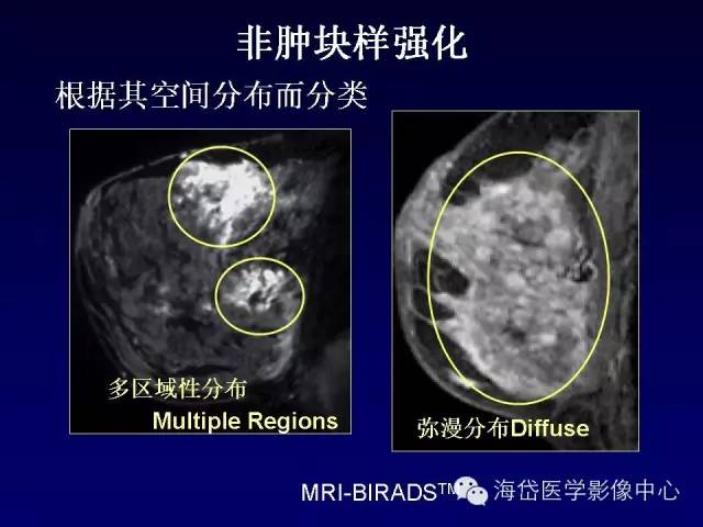 【PPT】乳腺MRI诊断解析 【PPT】乳腺MRI诊断解析