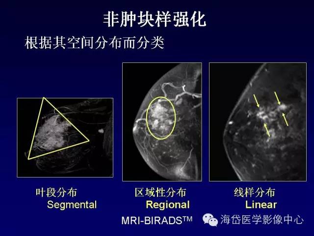 【PPT】乳腺MRI诊断解析 【PPT】乳腺MRI诊断解析
