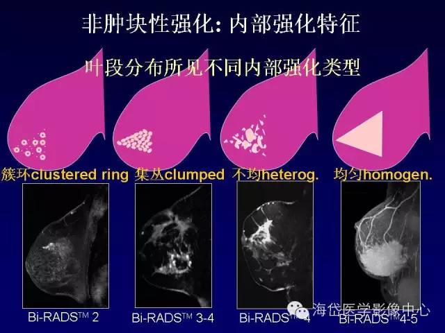 【PPT】乳腺MRI诊断解析 【PPT】乳腺MRI诊断解析