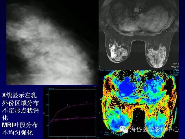 【PPT】乳腺MRI诊断解析 【PPT】乳腺MRI诊断解析