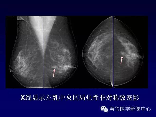 【PPT】乳腺MRI诊断解析 【PPT】乳腺MRI诊断解析