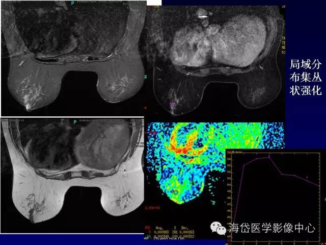 【PPT】乳腺MRI诊断解析 【PPT】乳腺MRI诊断解析