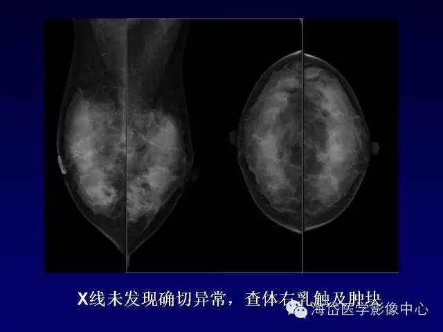 【PPT】乳腺MRI诊断解析 【PPT】乳腺MRI诊断解析