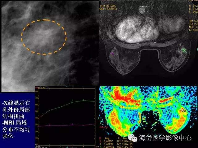 【PPT】乳腺MRI诊断解析 【PPT】乳腺MRI诊断解析