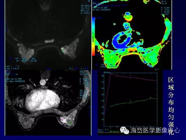 【PPT】乳腺MRI诊断解析 【PPT】乳腺MRI诊断解析