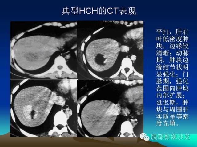 【PPT】不典型肝脏海绵状血管瘤影像诊断