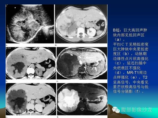 【PPT】不典型肝脏海绵状血管瘤影像诊断