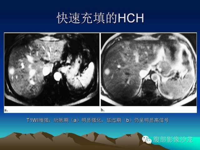 【PPT】不典型肝脏海绵状血管瘤影像诊断