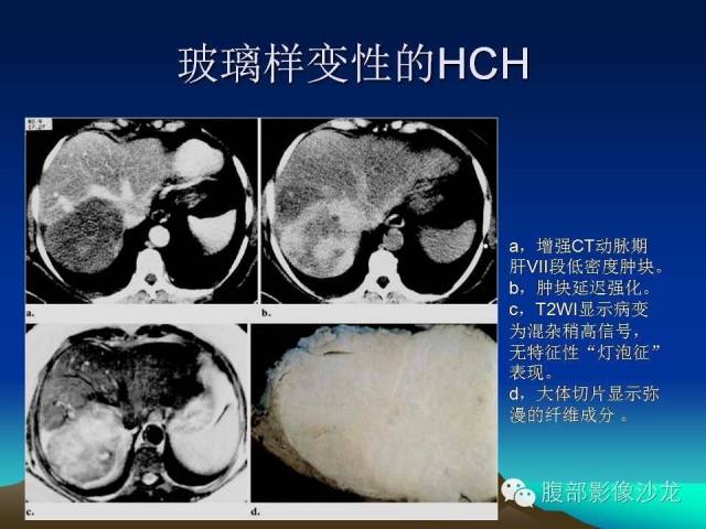 【PPT】不典型肝脏海绵状血管瘤影像诊断