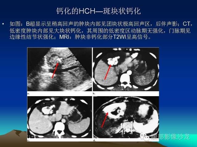 【PPT】不典型肝脏海绵状血管瘤影像诊断