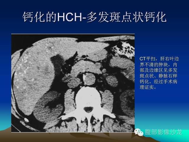 【PPT】不典型肝脏海绵状血管瘤影像诊断